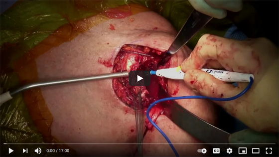 Anatomic Total Shoulder Arthroplasty using Exactech System Preserve Stem and Cage Glenoid